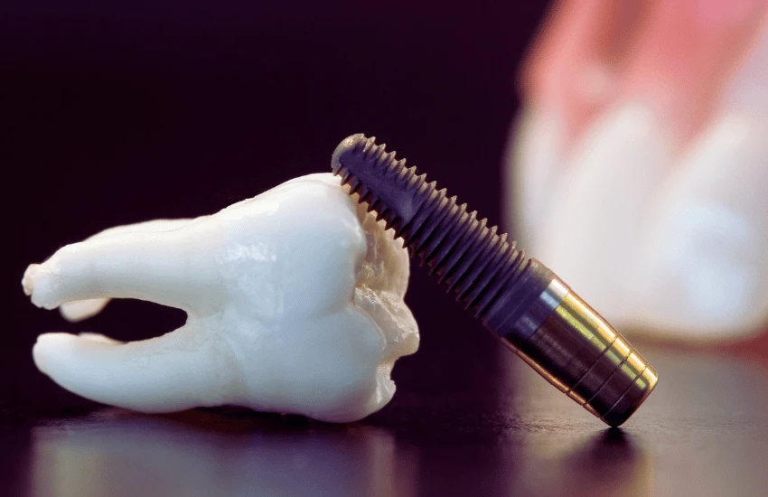 Implante Dentário