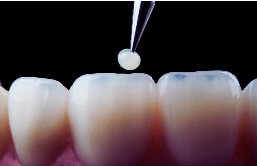 Restauração Dental