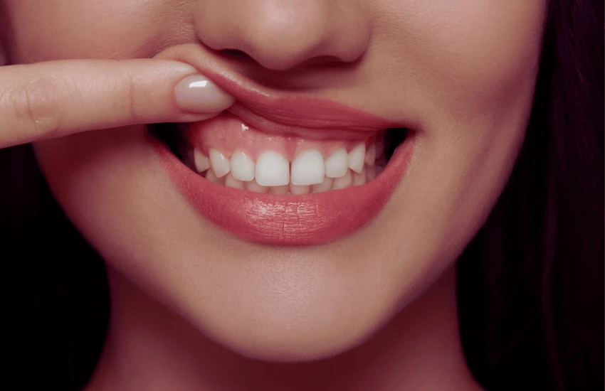 Periodontia - Tratamento de Gengiva